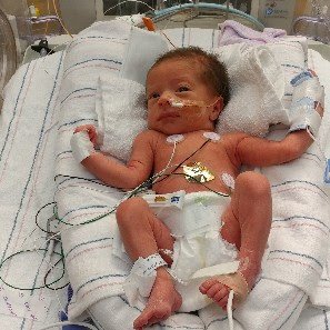 NICU close-up photo of Charlie or JoJo in 2017