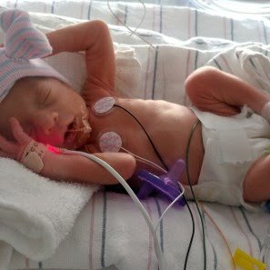 NICU close-up photo of one of the twins sleeping in 2017