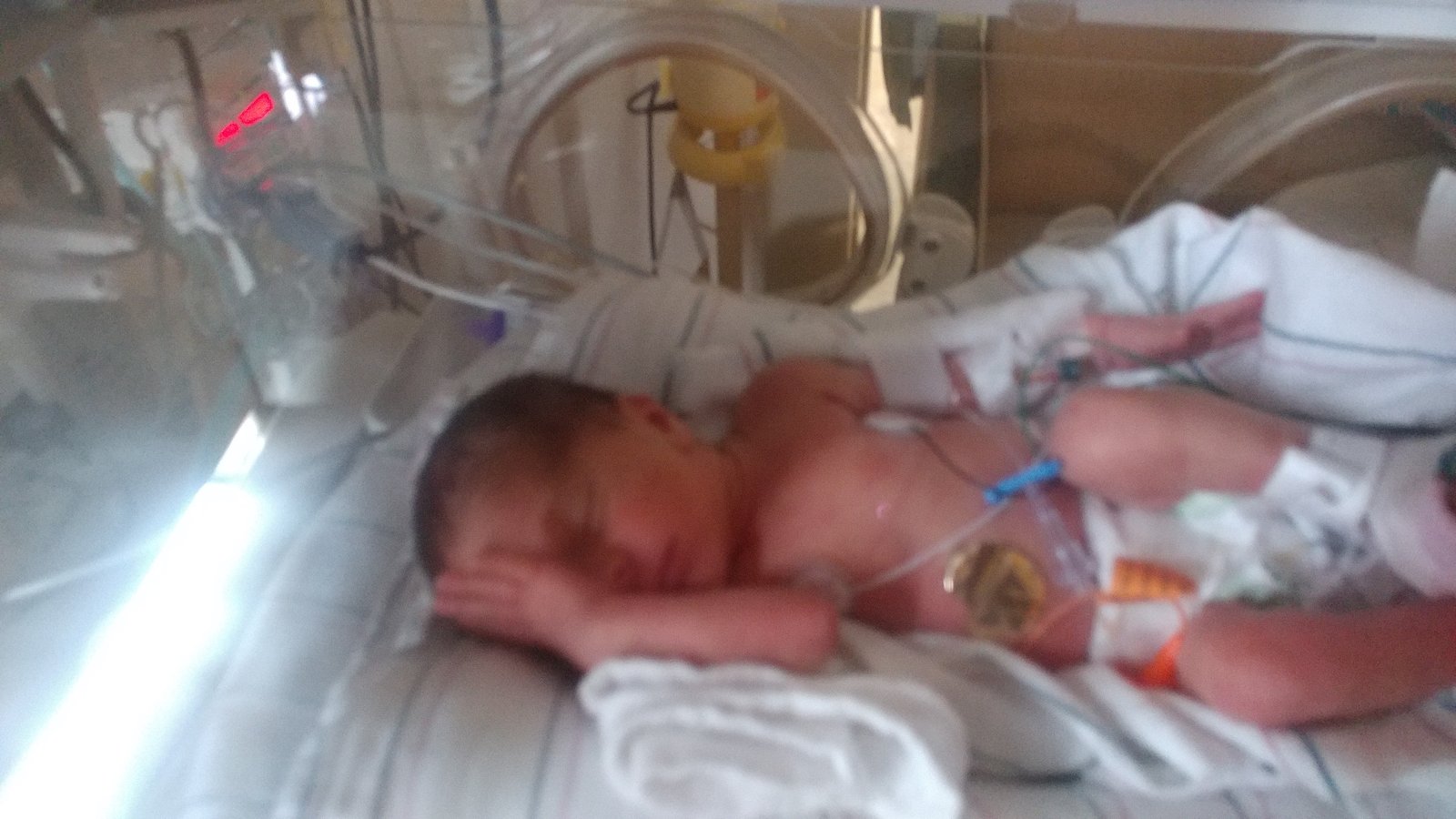 NICU close-up photo of one of the twins resting peacefully in 2017